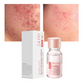 Salicylic Acid Spot Drying Lotion