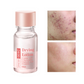 Salicylic Acid Spot Drying Lotion